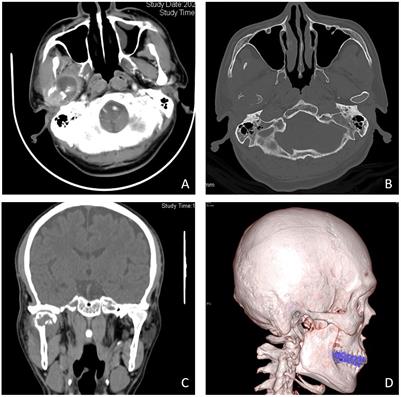 Case report: Condylar metastasis from hepatocellular carcinoma: An uncommon case report and literature review